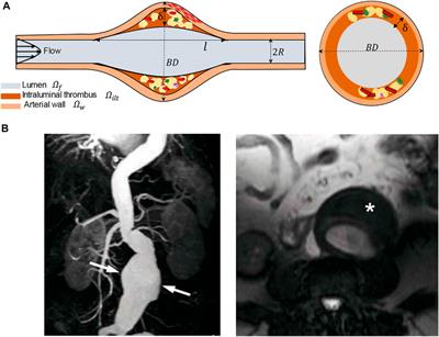 The Effects of Geometric Features of Intraluminal Thrombus on the Vessel Wall Oxygen Deprivation